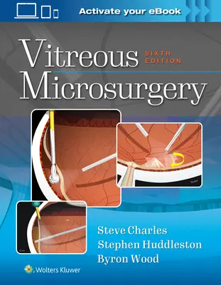 Microchirurgie du vitré - Vitreous Microsurgery