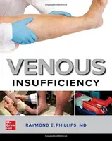 L'insuffisance veineuse - Venous Insufficiency