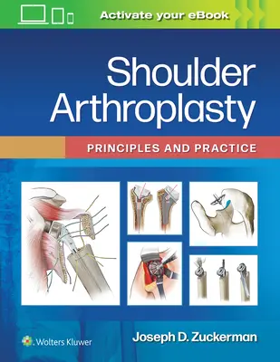 Arthroplastie de l'épaule : Principes et pratique - Shoulder Arthroplasty: Principles and Practice