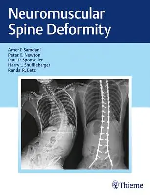 Déformation neuromusculaire de la colonne vertébrale - Neuromuscular Spine Deformity