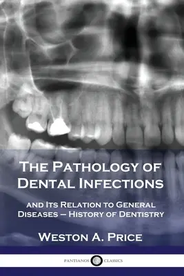 La pathologie des infections dentaires et ses rapports avec les maladies générales - Histoire de l'odontologie - The Pathology of Dental Infections: and Its Relation to General Diseases - History of Dentistry