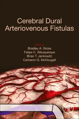 Fistules artérioveineuses durales cérébrales - Cerebral Dural Arteriovenous Fistulas
