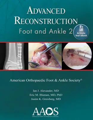 Reconstruction avancée : Foot and Ankle 2 : Print + eBook - Advanced Reconstruction: Foot and Ankle 2: Print + eBook