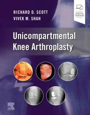 Arthroplastie unicompartimentale du genou - Unicompartmental Knee Arthroplasty