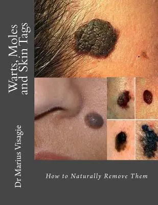 Verrues, grains de beauté et étiquettes de peau : Comment les éliminer naturellement - Warts, Moles and Skin Tags: How to Naturally Remove Them