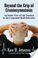 Au-delà de l'emprise de la craniosynostose : Une vue intérieure de la vie touchée par la malformation congénitale du crâne - Beyond the Grip of Craniosynostosis: An Inside View of Life Touched by the Congenital Skull Deformity