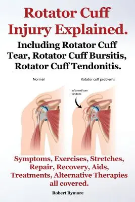 Les lésions de la coiffe des rotateurs expliquées. Y compris la déchirure de la coiffe des rotateurs, la bursite de la coiffe des rotateurs, la tendinite de la coiffe des rotateurs. Symptômes, exercices, étirements, réparation, traitement. - Rotator Cuff Injury Explained. Including Rotator Cuff Tear, Rotator Cuff Bursitis, Rotator Cuff Tendonitis. Symptoms, Exercises, Stretches, Repair, Re