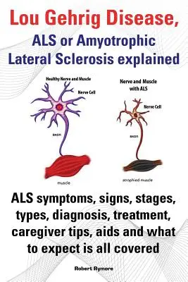 La maladie de Lou Gehrig, la SLA ou sclérose latérale amyotrophique expliquée. Symptômes, signes, stades, types, diagnostic, traitement, conseils pour les soignants, sida et maladies infectieuses. - Lou Gehrig Disease, ALS or Amyotrophic Lateral Sclerosis Explained. ALS Symptoms, Signs, Stages, Types, Diagnosis, Treatment, Caregiver Tips, AIDS and