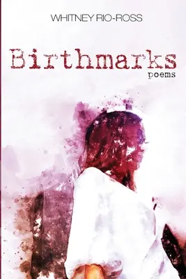 Taches de naissance - Birthmarks