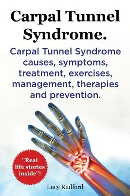 Syndrome du canal carpien, Cts. Syndrome du canal carpien, Cts Causes, Symptômes, Traitement, Exercices, Gestion, Thérapies et Prévention. - Carpal Tunnel Syndrome, Cts. Carpal Tunnel Syndrome Cts Causes, Symptoms, Treatment, Exercises, Management, Therapies and Prevention.