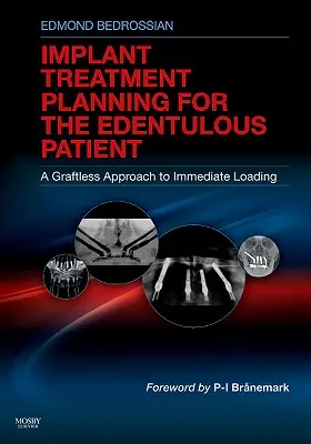 Planification du traitement implantaire pour le patient édenté : Une approche sans greffe de la mise en charge immédiate - Implant Treatment Planning for the Edentulous Patient: A Graftless Approach to Immediate Loading