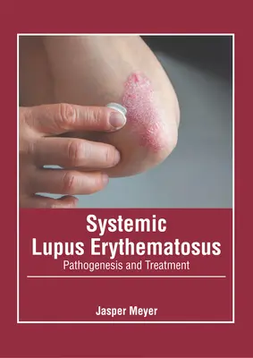 Lupus érythémateux systémique : Pathogenèse et traitement - Systemic Lupus Erythematosus: Pathogenesis and Treatment