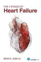 Les 4 étapes de l'insuffisance cardiaque - The 4 Stages of Heart Failure