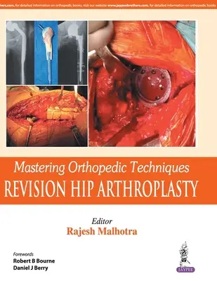 Maîtrise des techniques orthopédiques : Révision de l'arthroplastie totale de la hanche - Mastering Orthopedic Techniques: Revision Total Hip Arthroplasty