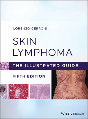 Le lymphome cutané : Le guide illustré - Skin Lymphoma: The Illustrated Guide