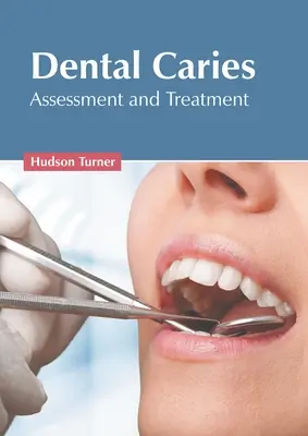 Caries dentaires : Évaluation et traitement - Dental Caries: Assessment and Treatment