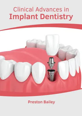 Avancées cliniques en dentisterie implantaire - Clinical Advances in Implant Dentistry