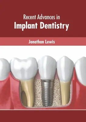 Progrès récents en dentisterie implantaire - Recent Advances in Implant Dentistry