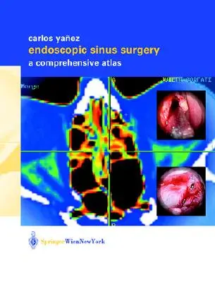 Chirurgie endoscopique des sinus : Un atlas complet - Endoscopic Sinus Surgery: A Comprehensive Atlas