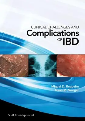 Défis cliniques et complications de l'Ibd - Clinical Challenges and Complications of Ibd