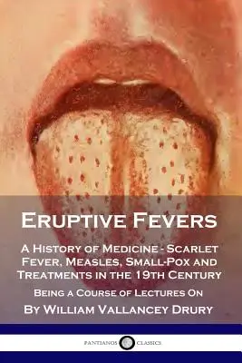 Fièvres éruptives : Une histoire de la médecine - la scarlatine, la rougeole, la variole et les traitements au 19e siècle - Un cours magistral - Eruptive Fevers: A History of Medicine - Scarlet Fever, Measles, Small-Pox and Treatments in the 19th Century - Being a Course of Lectu