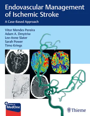 Prise en charge endovasculaire de l'accident vasculaire cérébral ischémique : Une approche basée sur les cas - Endovascular Management of Ischemic Stroke: A Case-Based Approach