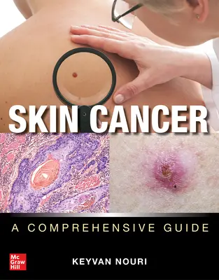 Le cancer de la peau : Un guide complet - Skin Cancer: A Comprehensive Guide