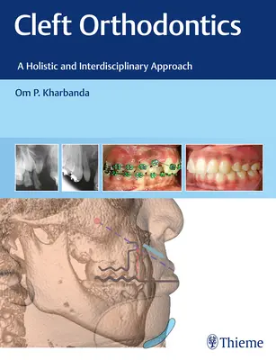 Orthodontie des fentes : Une approche holistique et interdisciplinaire - Cleft Orthodontics: A Holistic and Interdisciplinary Approach