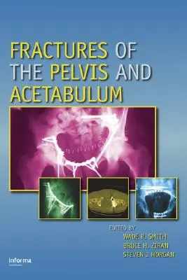 Fractures du bassin et de l'acétabulum - Fractures of the Pelvis and Acetabulum