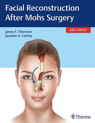 Reconstruction faciale après chirurgie de Mohs - Facial Reconstruction After Mohs Surgery