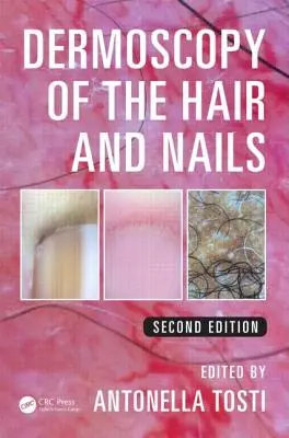 Dermoscopie des cheveux et des ongles - Dermoscopy of the Hair and Nails