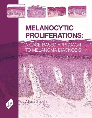 Proliférations mélanocytaires - Une approche basée sur les cas pour le diagnostic du mélanome - Melanocytic Proliferations - A Case-Based Approach to Melanoma Diagnosis