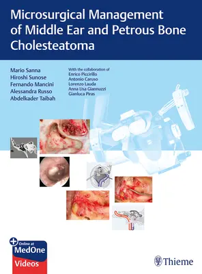 Gestion microchirurgicale du cholestéatome de l'oreille moyenne et de l'os pétreux - Microsurgical Management of Middle Ear and Petrous Bone Cholesteatoma