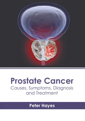 Le cancer de la prostate : Causes, symptômes, diagnostic et traitement - Prostate Cancer: Causes, Symptoms, Diagnosis and Treatment