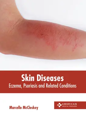 Maladies de la peau : Eczéma, psoriasis et affections connexes - Skin Diseases: Eczema, Psoriasis and Related Conditions