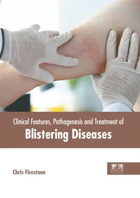 Caractéristiques cliniques, pathogénie et traitement des maladies vésiculeuses - Clinical Features, Pathogenesis and Treatment of Blistering Diseases