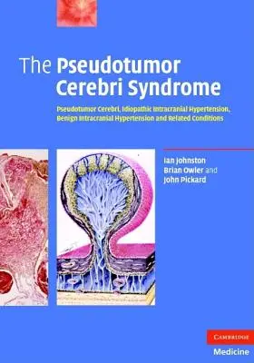 Le syndrome du pseudotumeur cérébral - The Pseudotumor Cerebri Syndrome