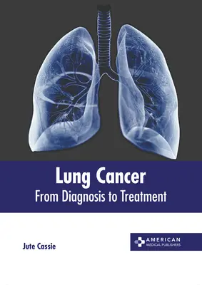 Le cancer du poumon : Du diagnostic au traitement - Lung Cancer: From Diagnosis to Treatment