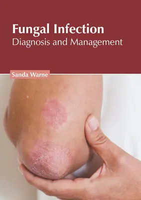 Infection fongique : Diagnostic et prise en charge - Fungal Infection: Diagnosis and Management