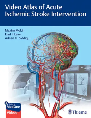 Atlas vidéo de l'intervention en cas d'accident vasculaire cérébral ischémique aigu - Video Atlas of Acute Ischemic Stroke Intervention