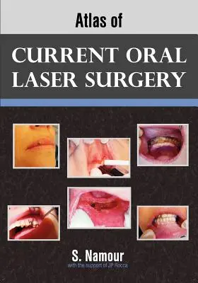 Atlas de la chirurgie orale au laser - Atlas of Current Oral Laser Surgery