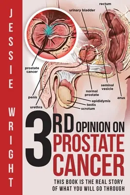 3e avis sur le cancer de la prostate - 3rd Opinion on Prostate Cancer