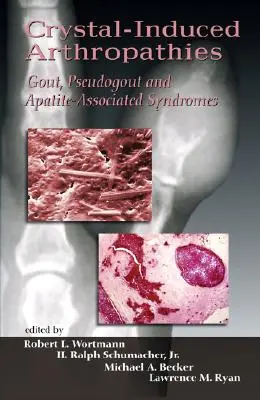 Arthropathies induites par les cristaux : Goutte, pseudogoutte et syndromes associés à l'apatite - Crystal-Induced Arthropathies: Gout, Pseudogout and Apatite-Associated Syndromes