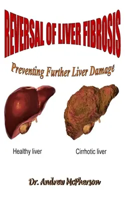 Inversion de la fibrose hépatique : Prévenir l'aggravation des lésions hépatiques - Reversal of Liver Fibrosis: Preventing Further Liver Damage