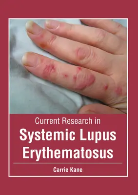 Recherche actuelle sur le lupus érythémateux systémique - Current Research in Systemic Lupus Erythematosus