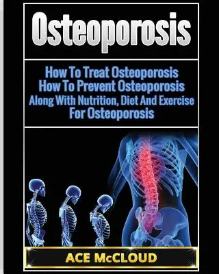 Ostéoporose : Comment traiter l'ostéoporose : Comment prévenir l'ostéoporose : Avec la nutrition, le régime et l'exercice pour l'ostéoporose - Osteoporosis: How To Treat Osteoporosis: How To Prevent Osteoporosis: Along With Nutrition, Diet And Exercise For Osteoporosis