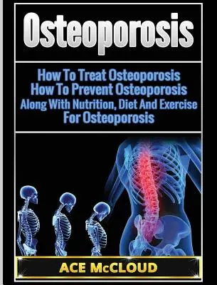 Ostéoporose : Comment traiter l'ostéoporose : Comment prévenir l'ostéoporose : Avec la nutrition, le régime et l'exercice pour l'ostéoporose - Osteoporosis: How To Treat Osteoporosis: How To Prevent Osteoporosis: Along With Nutrition, Diet And Exercise For Osteoporosis