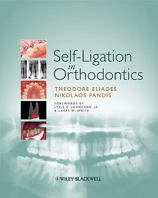 L'autoligature en orthodontie : Une approche de la biomécanique et du traitement fondée sur des données probantes - Self-Ligation in Orthodontics: An Evidence-Based Approach to Biomechanics and Treatment