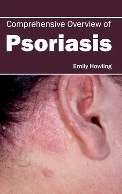 Vue d'ensemble du psoriasis - Comprehensive Overview of Psoriasis
