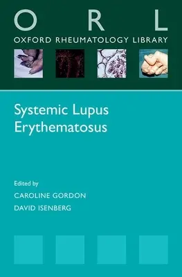 Lupus érythémateux disséminé - Systemic Lupus Erythematosus